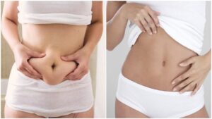 abdominoplastie perte de poids