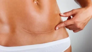 Cicatrices abdominoplastie