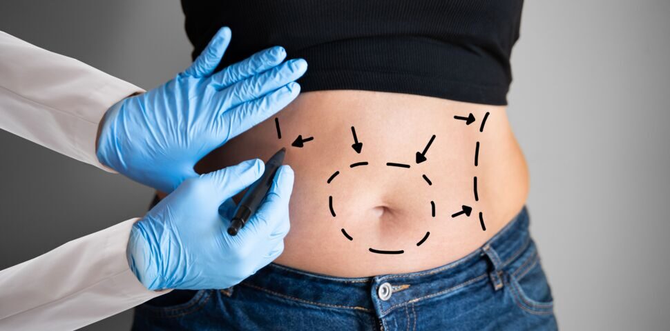 Prix abdominoplastie circulaire Tunisie