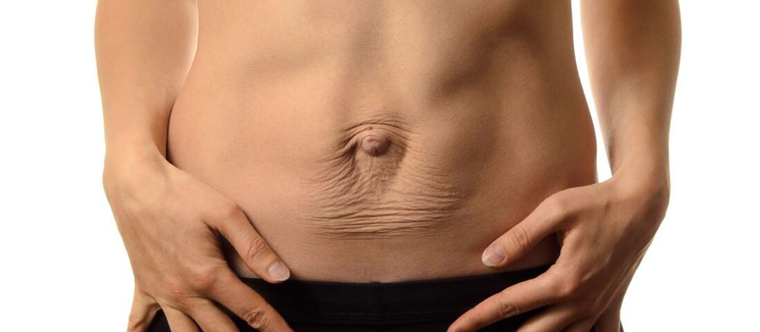 Comment enlever une diastasis abdominale ?