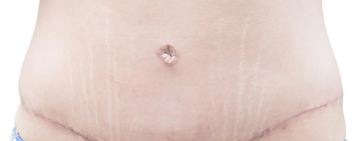 Comment est le nombril après une abdominoplastie ?