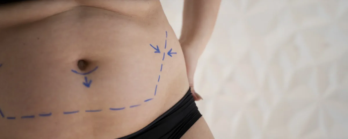Est-il possible de reprendre du ventre après une abdominoplastie ?
