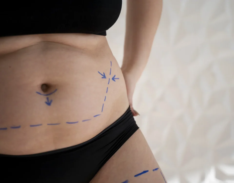 Est-il possible de reprendre du ventre après une abdominoplastie ?