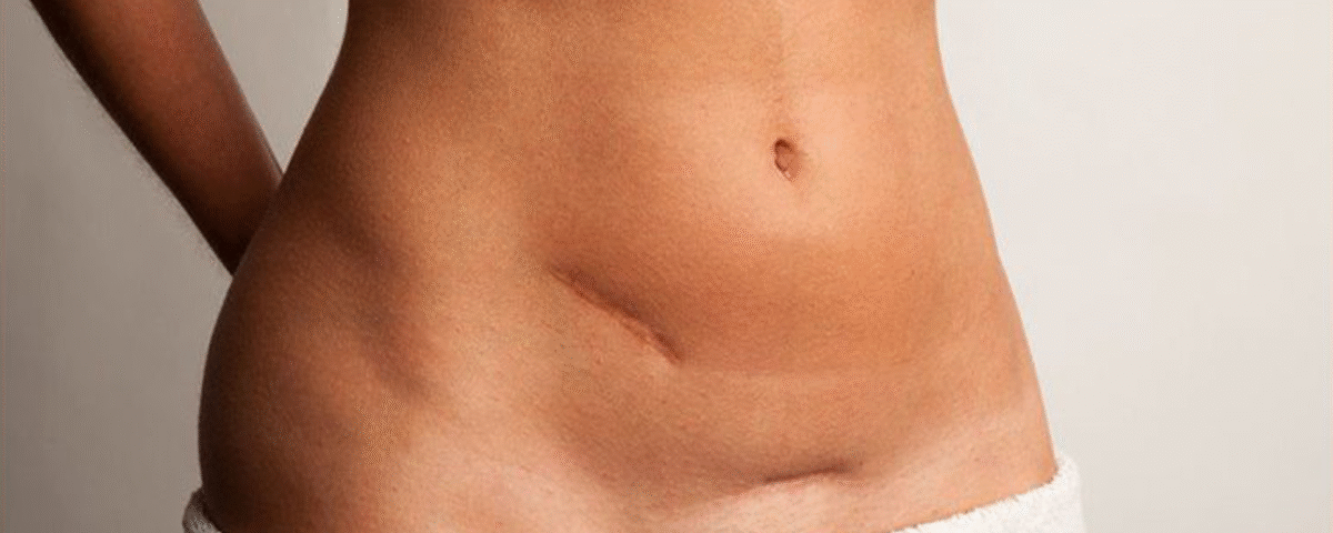 Est-il possible d'éviter la fibrose après une abdominoplastie ?