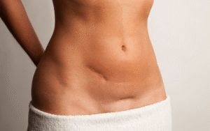Est-il possible d'éviter la fibrose après une abdominoplastie ?