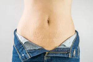 Est-il possible d'enlever les vergetures du ventre par la chirurgie ?