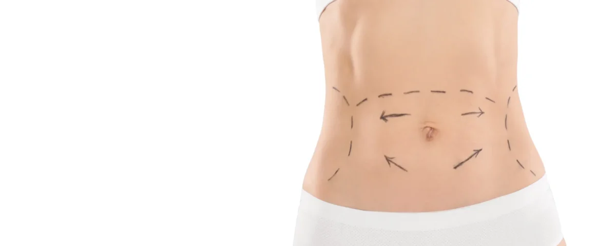 Une mini-abdominoplastie permet-elle d’enlever le nombril ?