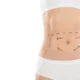 Une mini-abdominoplastie permet-elle d’enlever le nombril ?