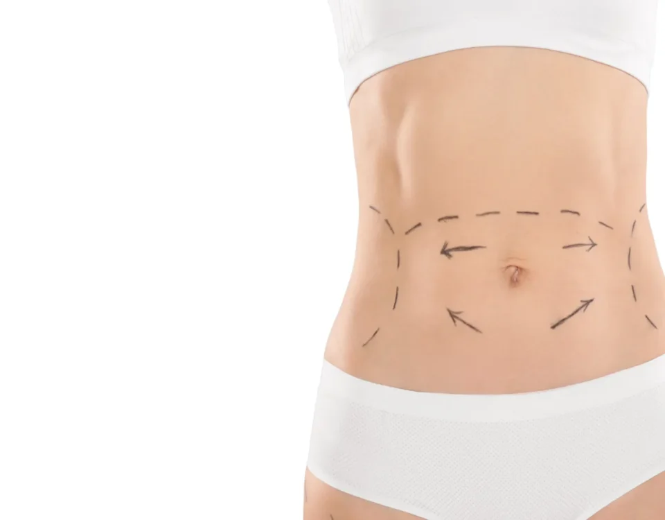 Une mini-abdominoplastie permet-elle d’enlever le nombril ?