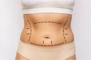 Comment puis-je me débarrasser d'un ventre qui retombe sur mon pubis ?