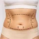 Comment puis-je me débarrasser d'un ventre qui retombe sur mon pubis ?