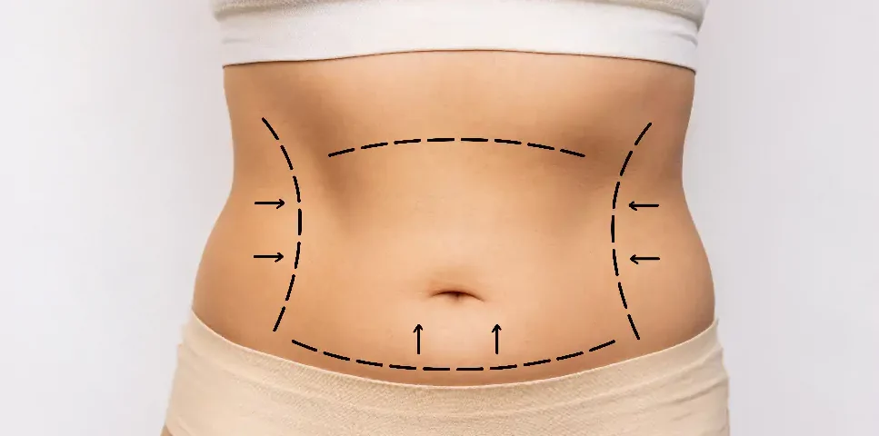 Comment puis-je me débarrasser d'un ventre qui retombe sur mon pubis ?