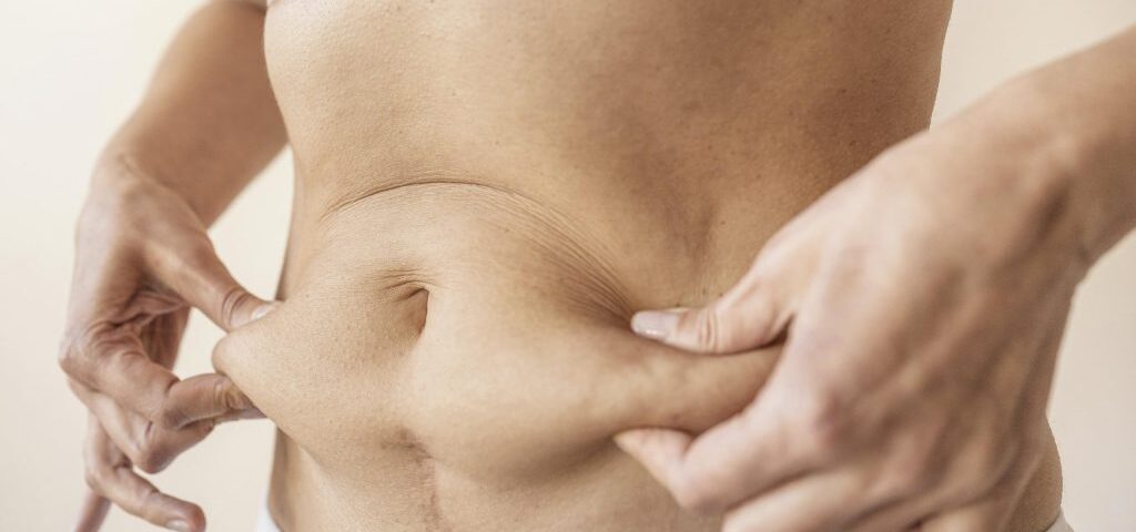 Est-il possible de corriger un diastasis sans chirurgie ?