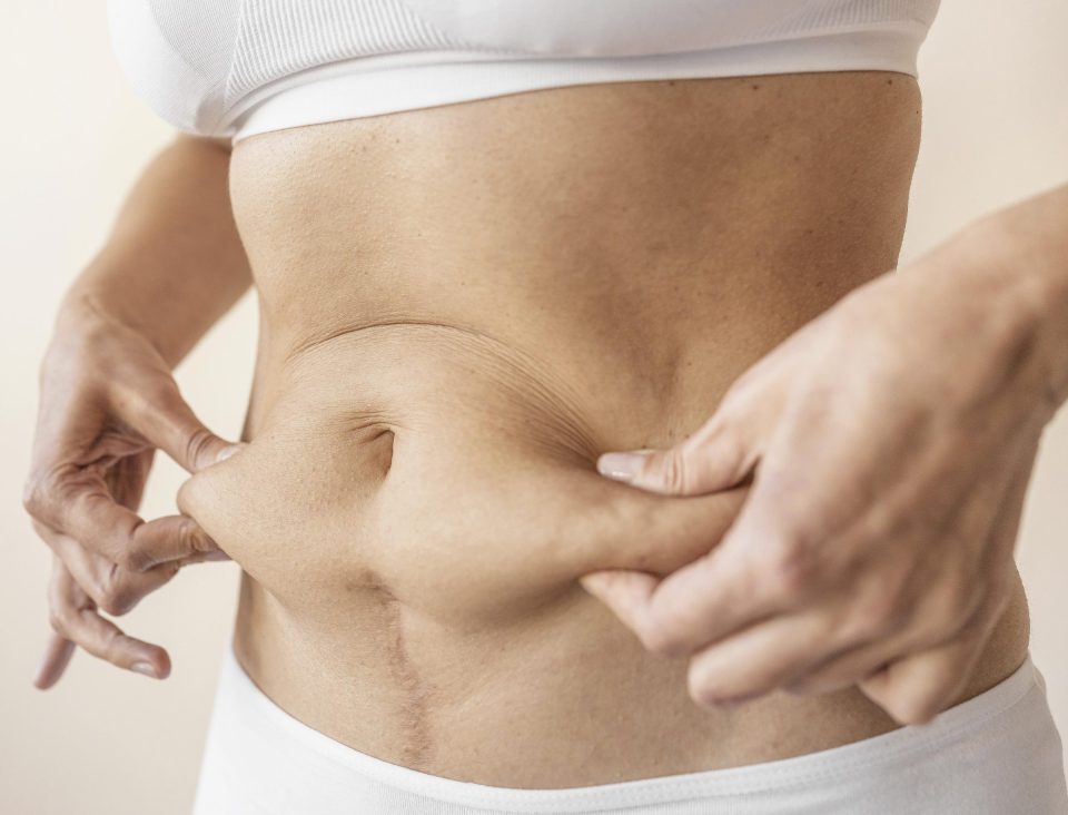 Est-il possible de corriger un diastasis sans chirurgie ?