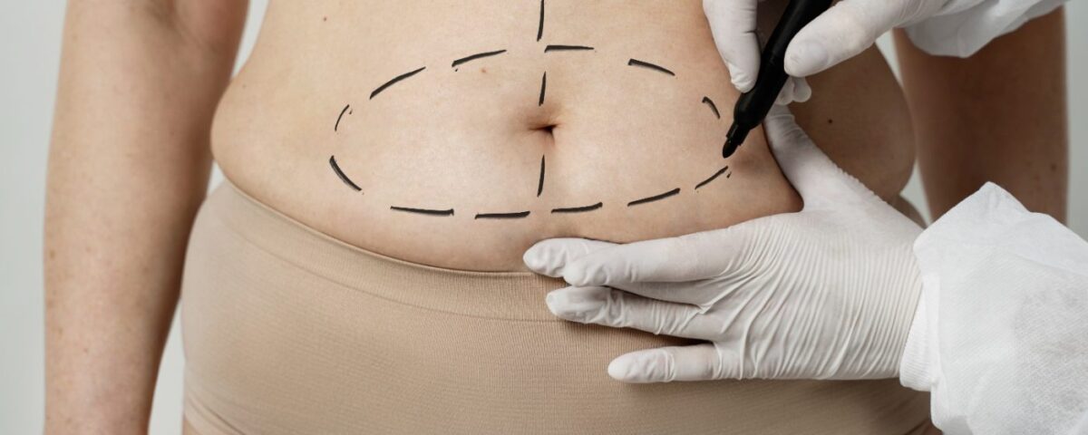 Quelle est la chirurgie pour retirer la peau du ventre ?