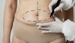 Quelle est la chirurgie pour retirer la peau du ventre ?