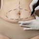 Quelle est la chirurgie pour retirer la peau du ventre ?