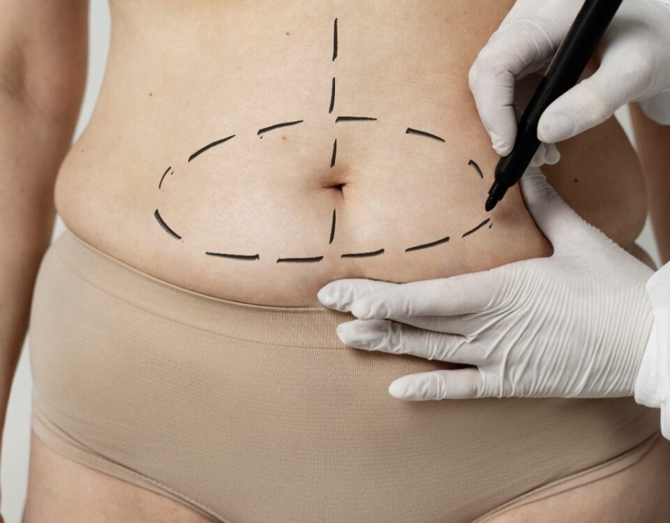 Quelle est la chirurgie pour retirer la peau du ventre ?