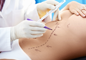 liposuccion du ventre est accompagnée d'une liposuccion du tablier abdominal