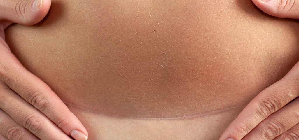 Comment sont les cicatrices d'une abdominoplastie 3 mois après ?