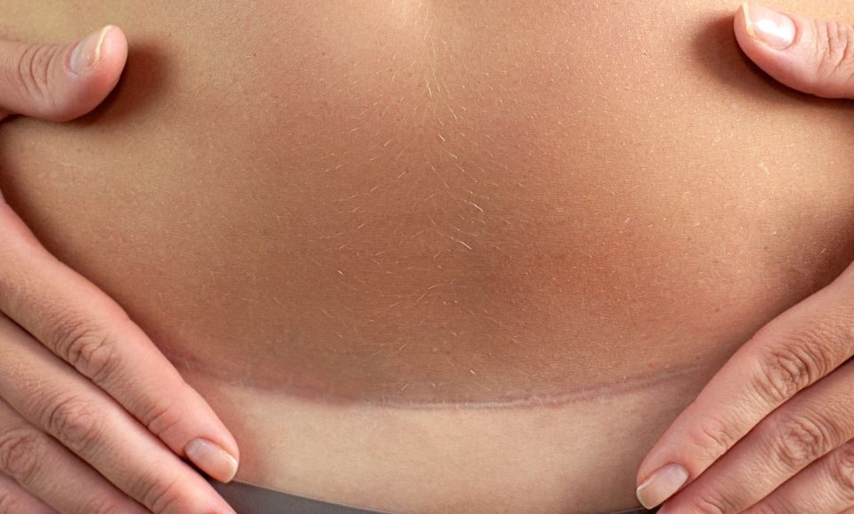 Comment sont les cicatrices d'une abdominoplastie 3 mois après ?