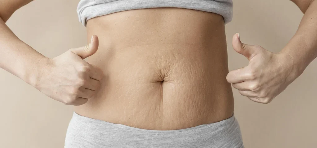Comment savoir s'il s'agit de graisse abdominale ou de diastasis recti ?