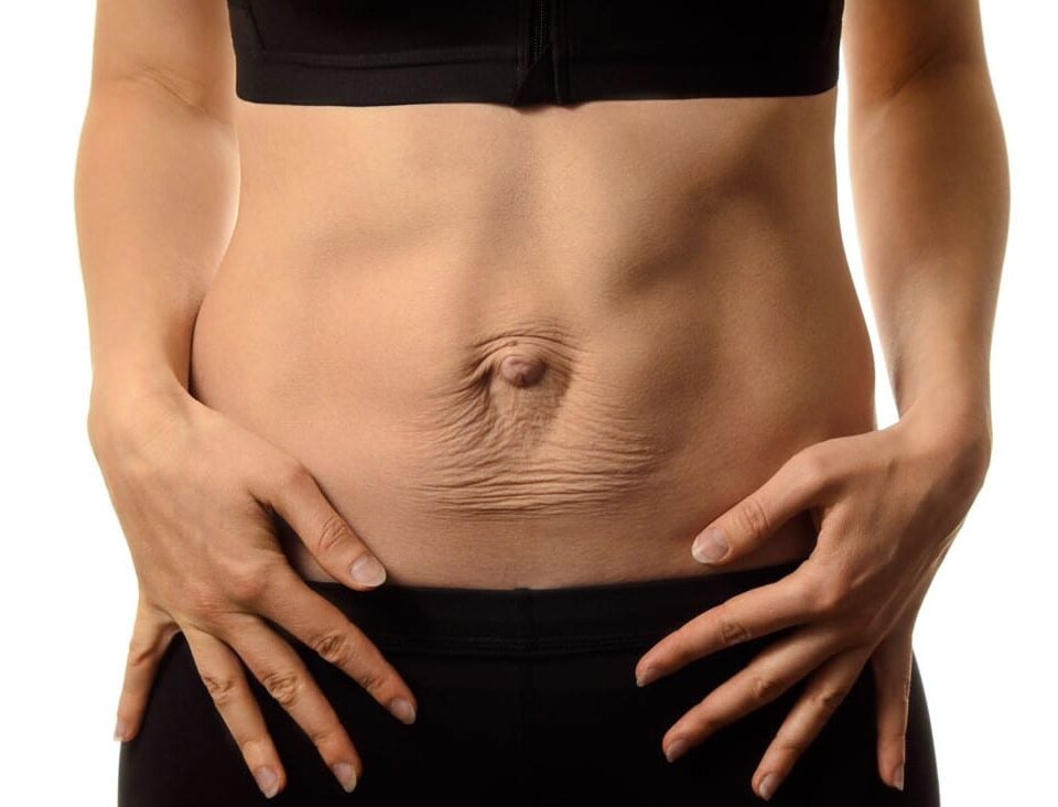 Est-il possible d’avoir un ventre plat avec un diastasis ?