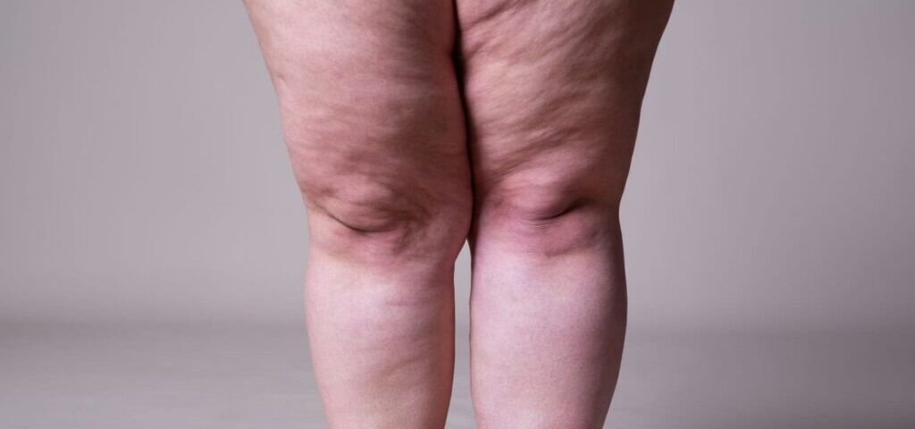 Chirurgie du Lipœdème en Tunisie