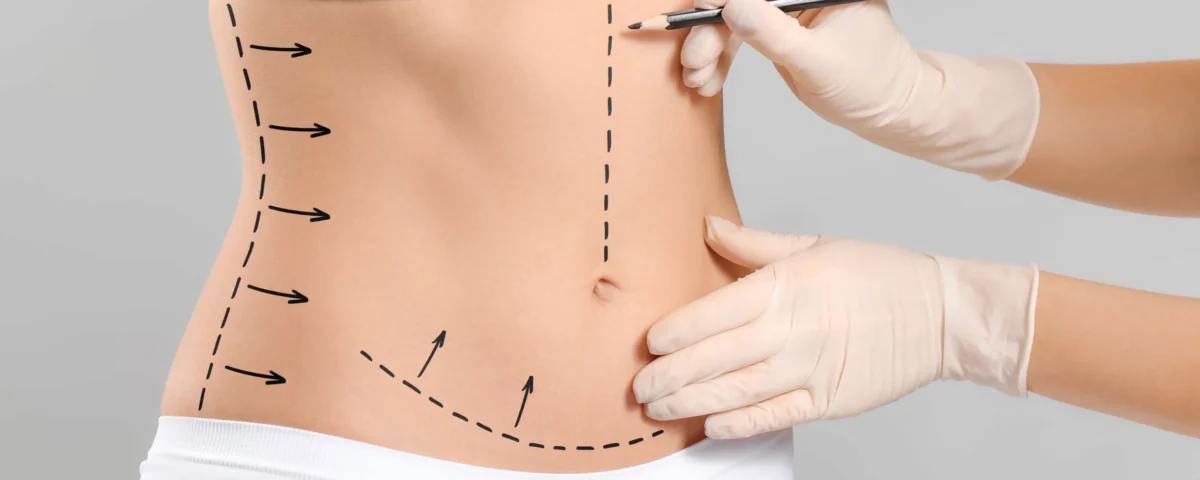 High Definition Abdominoplastie en Tunisie