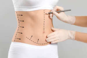 High Definition Abdominoplastie en Tunisie