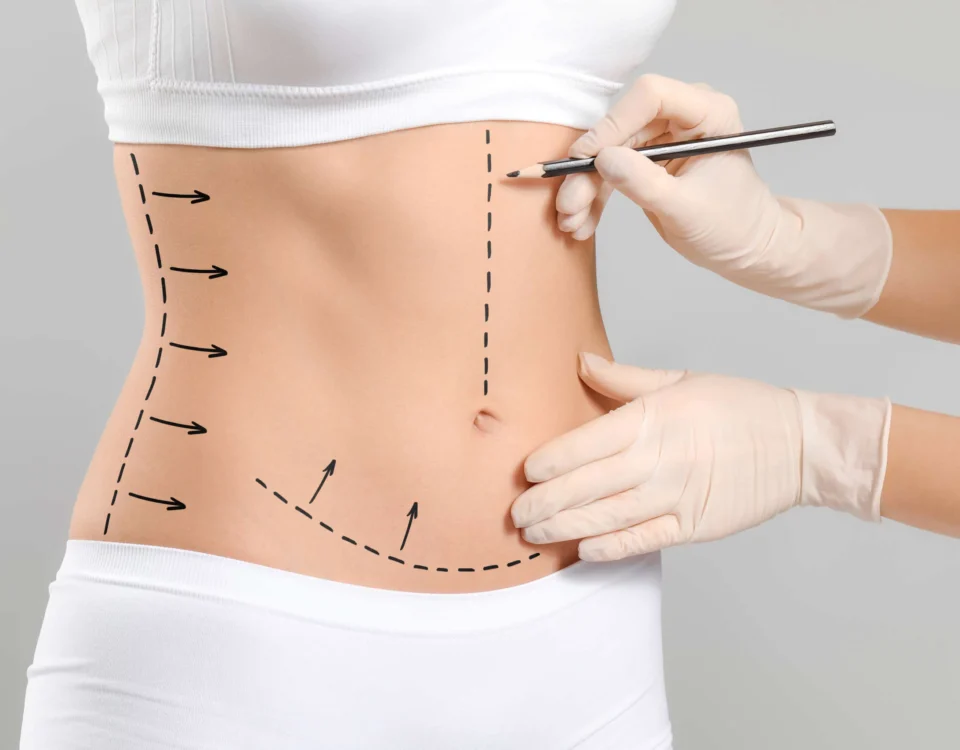 High Definition Abdominoplastie en Tunisie