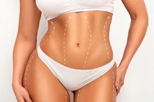 Le traitement J Plasma est-il aussi efficace qu'une abdominoplastie ?