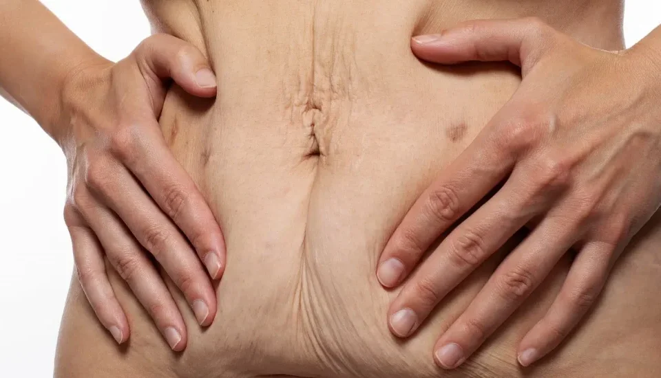 Pourquoi ma taille est-elle plus large après une abdominoplastie ?