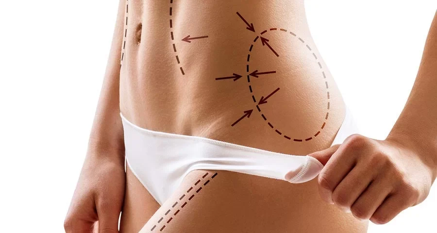 Traitement du Lipœdème par BodyTite