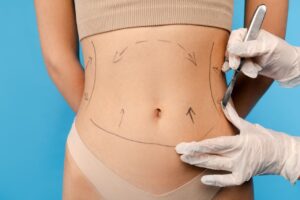Abdominoplastie et reconstruction abdominale