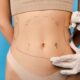 Abdominoplastie et reconstruction abdominale