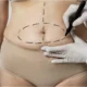 Chirurgie Esthétique de la Ceinture Abdominale