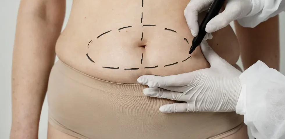 Chirurgie Esthétique de la Ceinture Abdominale