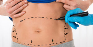 Abdominoplastie circulaire (360°)