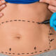 Abdominoplastie circulaire (360°)
