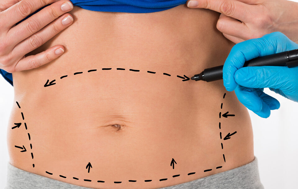 Abdominoplastie circulaire (360°)
