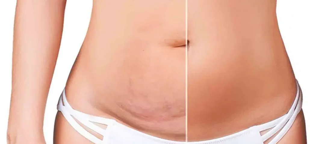 Abdominoplastie classique vs mini-abdominoplastie