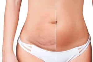 Abdominoplastie classique vs mini-abdominoplastie