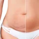 Abdominoplastie classique vs mini-abdominoplastie