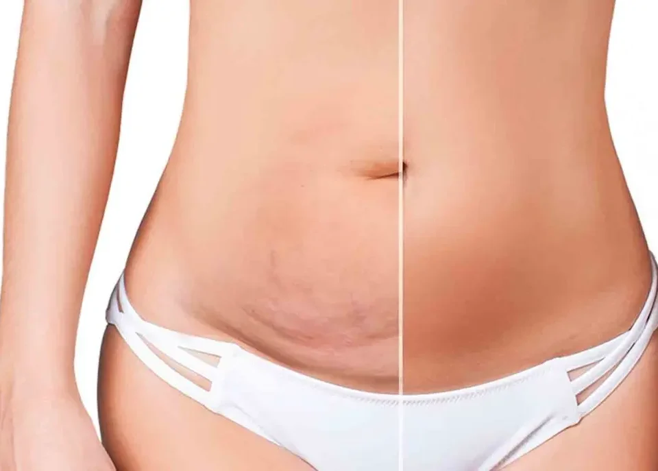 Abdominoplastie classique vs mini-abdominoplastie