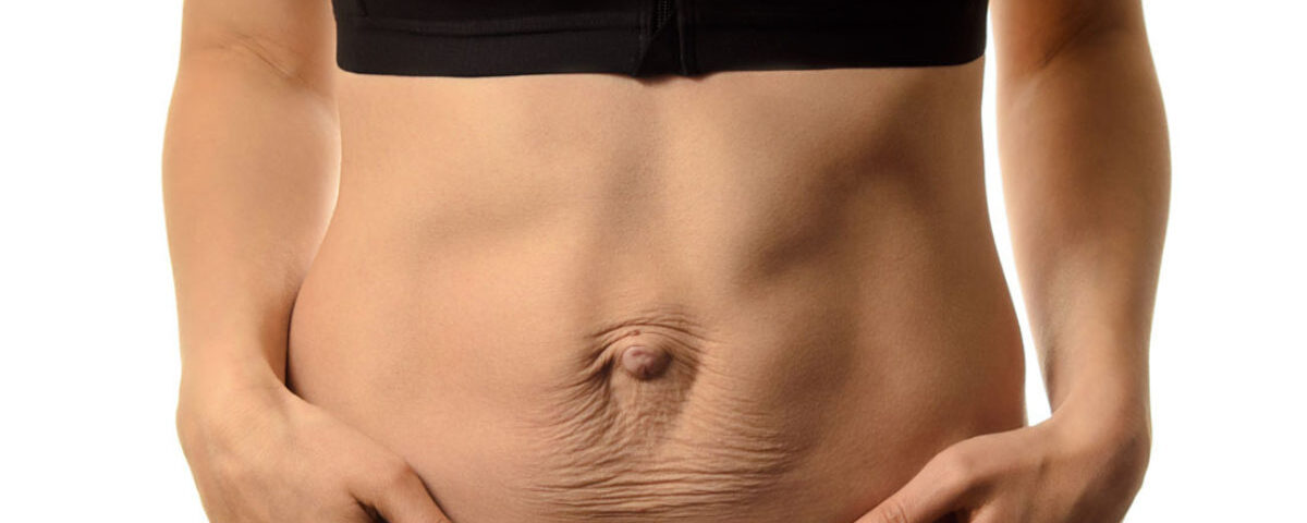 Abdominoplastie et correction de diastasis abdominal