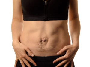 Abdominoplastie et correction de diastasis abdominal
