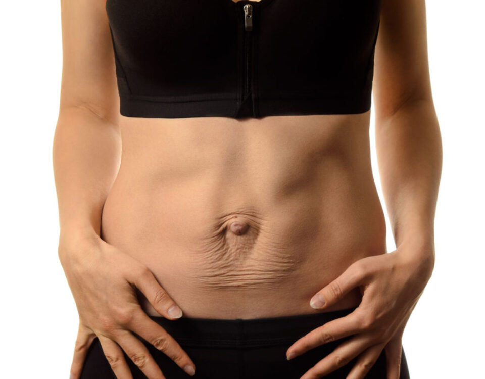 Abdominoplastie et correction de diastasis abdominal