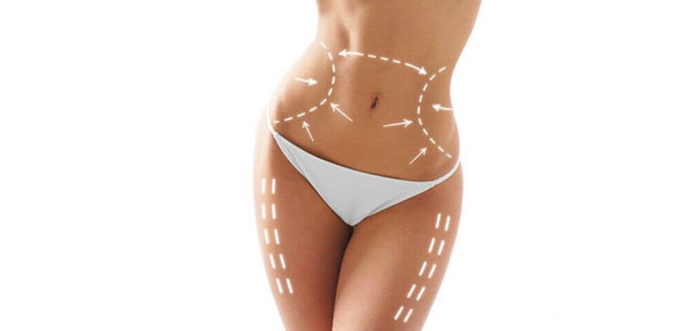 Comment choisir entre abdominoplastie classique et lipo-abdominoplastie