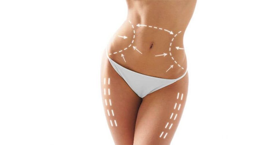 Comment choisir entre abdominoplastie classique et lipo-abdominoplastie